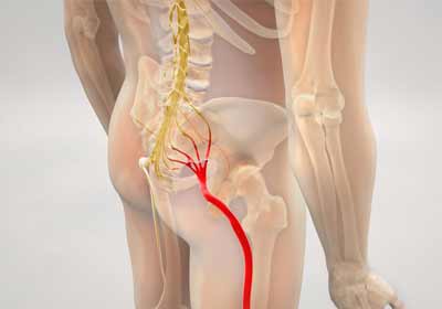 Sciatica Pain Treatment